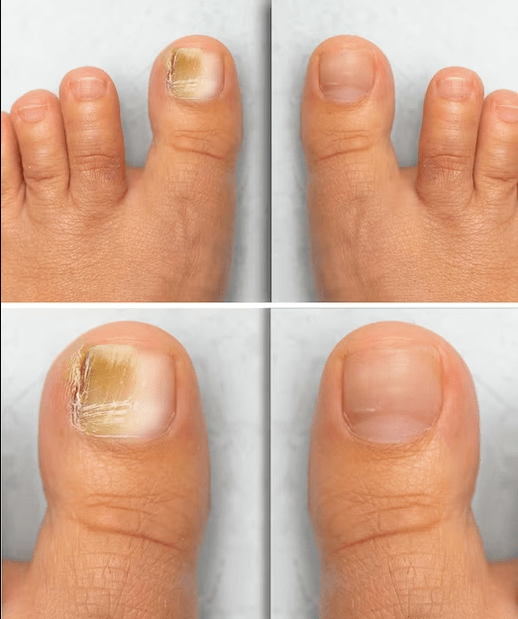Foot mushrooms - before and after treatment before and after the ZXCVBNMQWT Cream