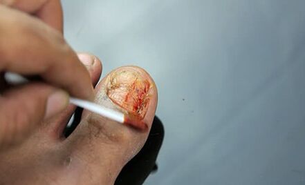 The treatment of a lesion with a mushroom