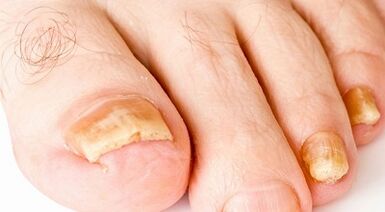 How to treat nail fungi