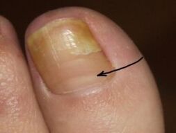 How to recognize the existence of a nail mushroom in the thumb of the foot