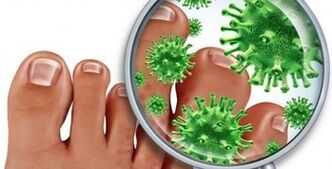 How to treat a fungal infection into the fingers