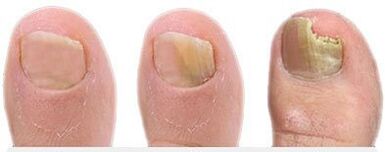 Stages of development of mushrooms in the nail