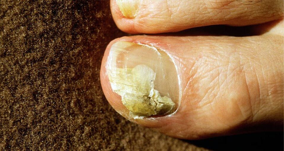 Foot mushroom