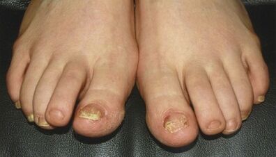 Signs and signs of fungi in nails