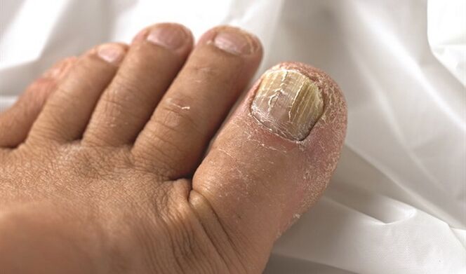 Spread the micse lesion on the nail plate