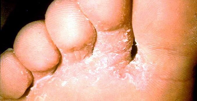 The lesion of the skin mushroom between toes