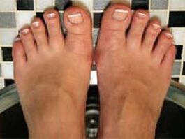 Mushrooms in the skin of nails and legs