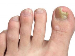 Yellow spots on the nails of foot signs of fungi