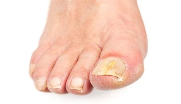Yellowing of the nail due to fungal infection