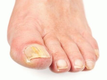 damage to the nail fungus