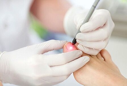 laser treatment of nail fungus