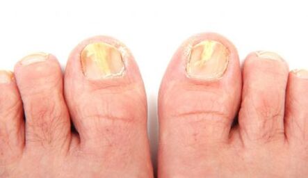 manifestations of nail fungus