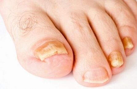 yellowing of toenails due to fungus