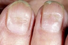 signs of fungus on the nails