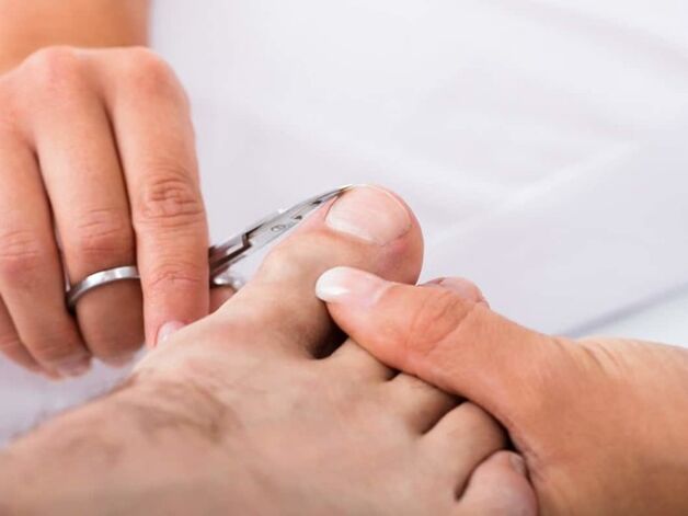 removal of toenails