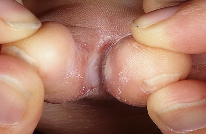 squamous-hyperkeratotic form of fungus