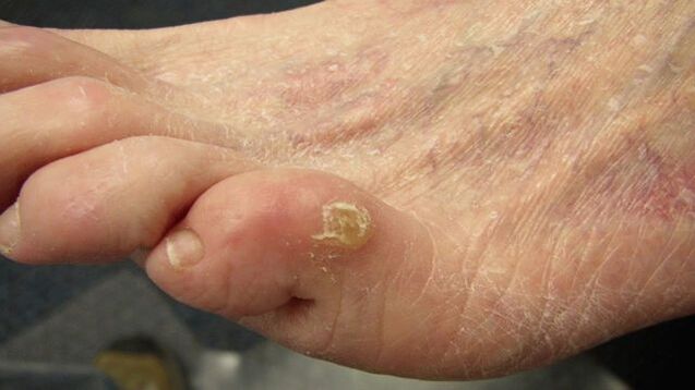 the advanced stage of the fungus