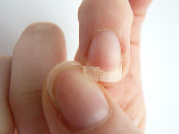 separation of nails due to fungus