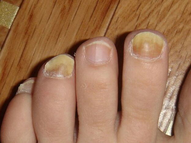 signs of toenail fungus