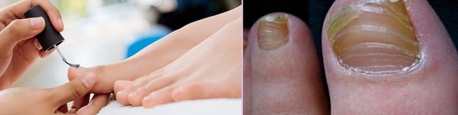 apply varnish to treat fungus