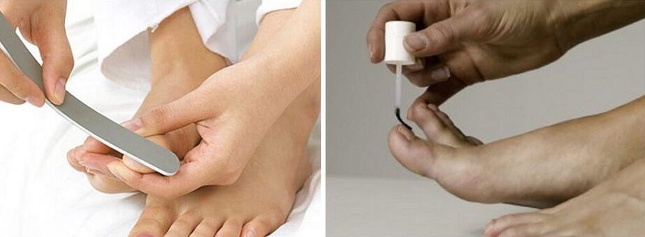 nail fungus treatment with varnish